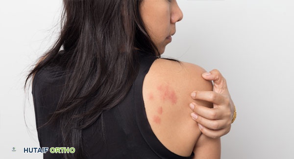 صورة توضيحية لنوبة التهاب المفاصل