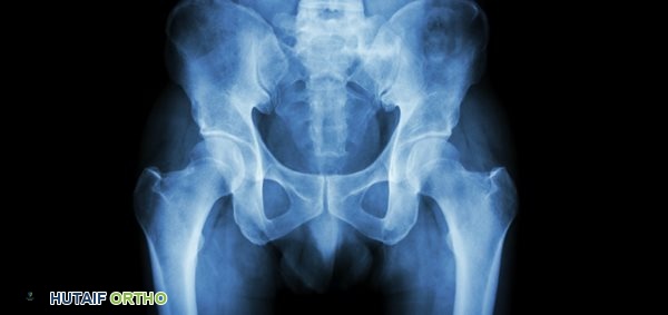 متى يشير ألم الورك إلى التهاب المفاصل؟ دليل شامل مع الأستاذ الدكتور محمد هطيف