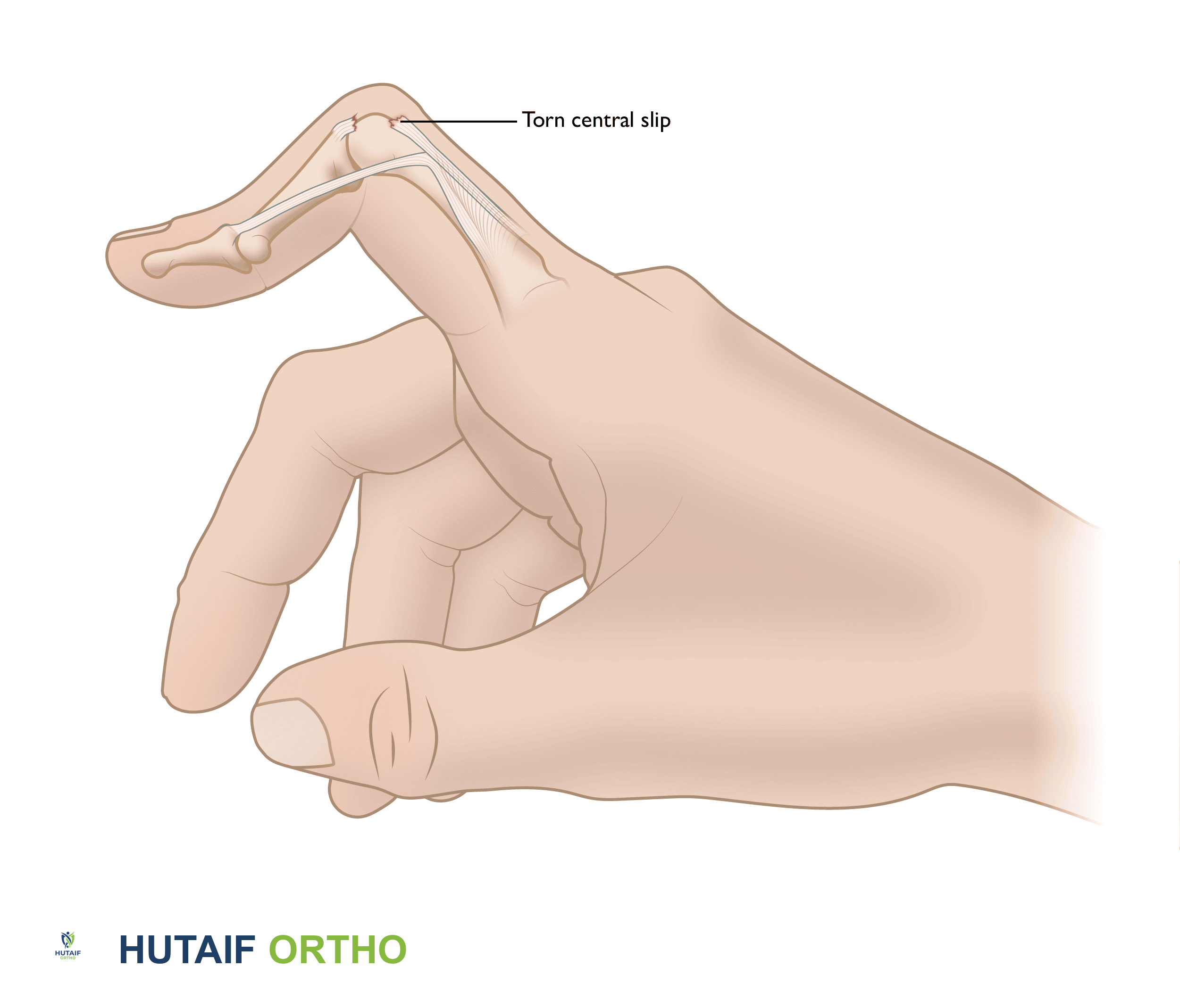 تشوه العروة (Boutonnière Deformity) الأسباب الأعراض والعلاج مع الدكتور محمد هطيف