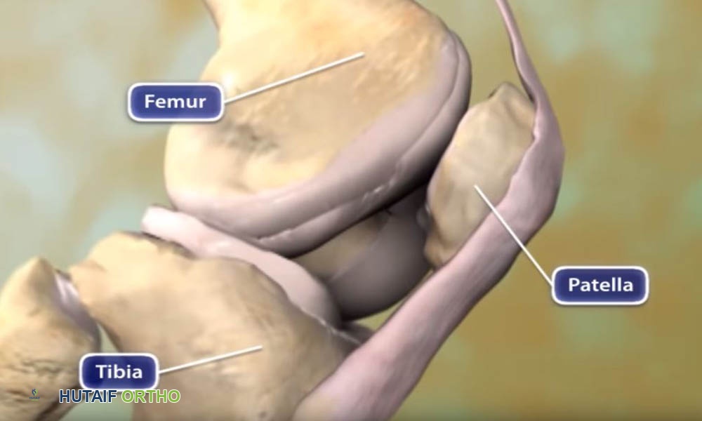 Osteoarthritis of the Knee Animation رسوم متحركة لخشونة مفصل الركبة
