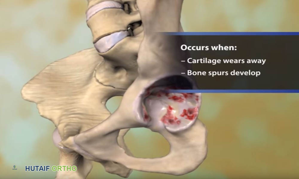 Osteoarthritis of the Hip Animation رسوم متحركة لخشونة مفصل الورك