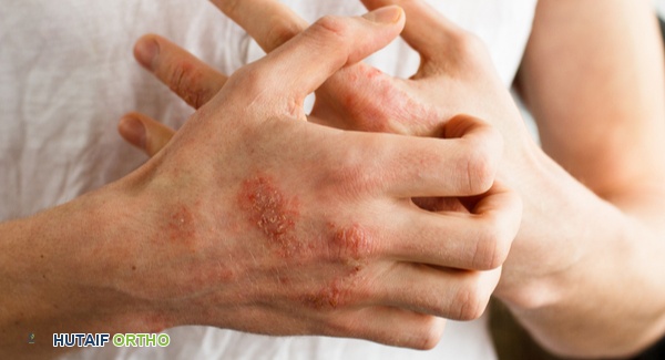 صورة توضيحية لـ التهاب المفاصل اليفعي وأعراضه الجلدية المتنوعة: دليل شامل للمرضى