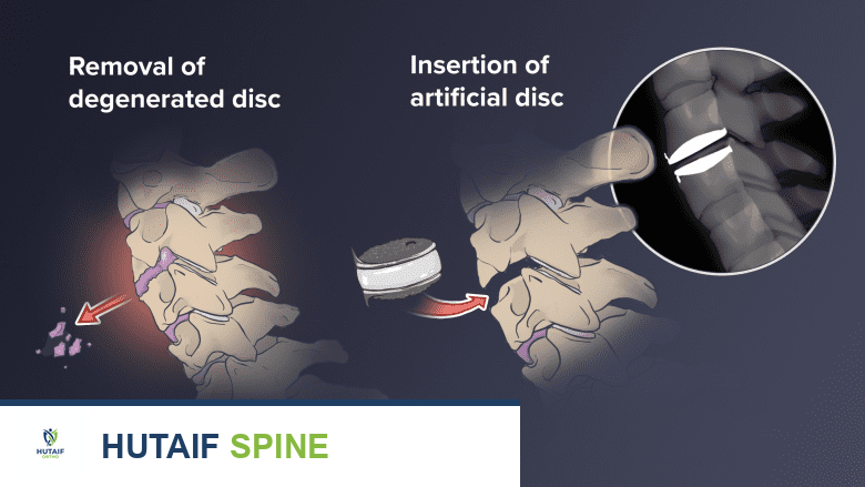 Illustration showing anterior decompression surgery.