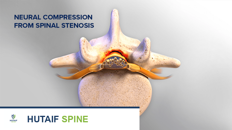 Illustration showing lumbar spianl stenosis.