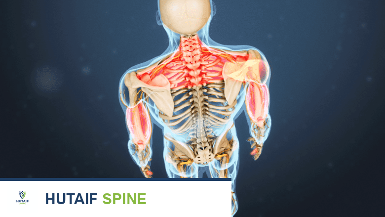 صورة توضيحية لـ خشونة فقرات الرقبة: دليل شامل للأعراض، التشخيص، والعلاج مع الأستاذ الدكتور محمد هطيف