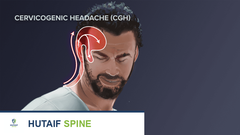 صورة توضح صداع عنقي المنشأ.