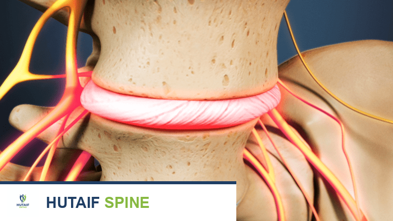 Degenerated spinal disc causing nerve compression.
