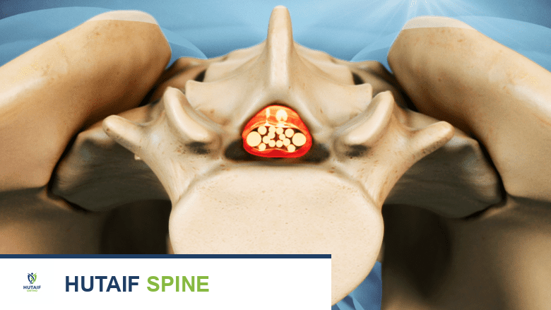 صورة توضيحية للعمود الفقري القطني الطبيعي والفقرة المتضيقة