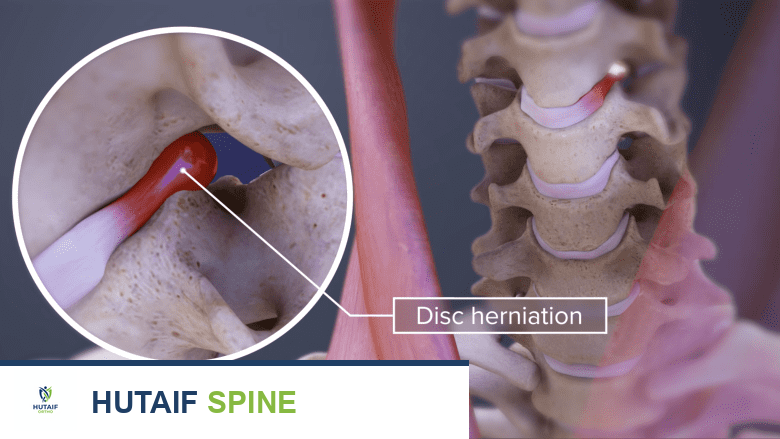 Illustration showing laterally herniated cervical disc.