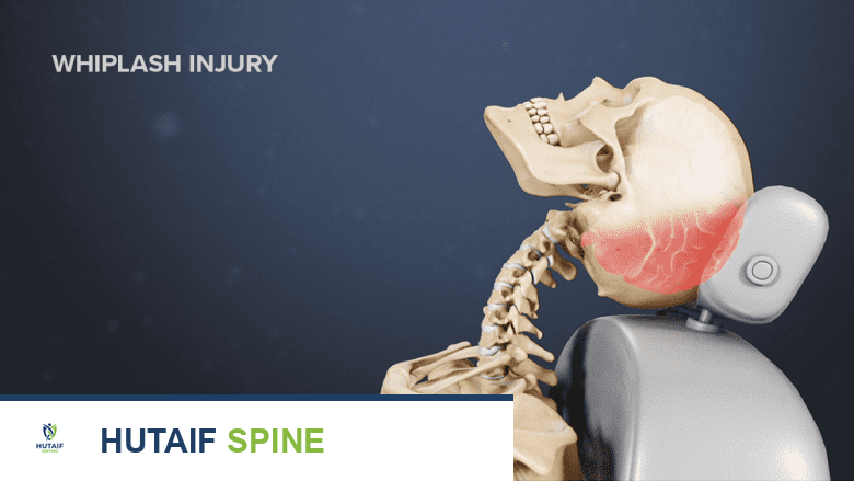 Illustration showing a skeleton with whiplash injury.