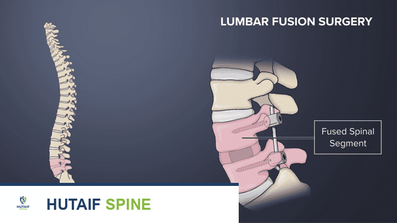 توضيح طبي: جراحة دمج الفقرات لعلاج الانزلاق الفقاري البرزخي: دليل شامل من الأستاذ الدكتور محمد هطيف