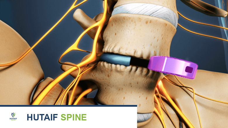 صورة توضيحية لـ جراحات علاج مرض القرص التنكسي: دليل شامل لاستعادة حياتك مع الأستاذ الدكتور محمد هطيف