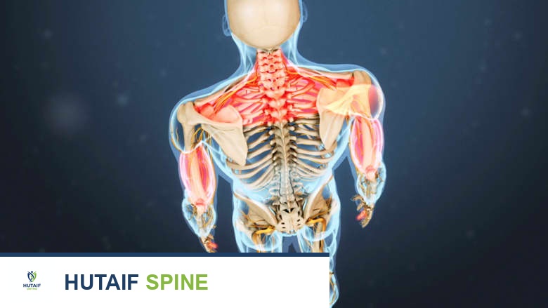 صورة توضيحية لـ إصابة الرقبة (الارتجاج الرقبي): دليل شامل من الأستاذ الدكتور محمد هطيف