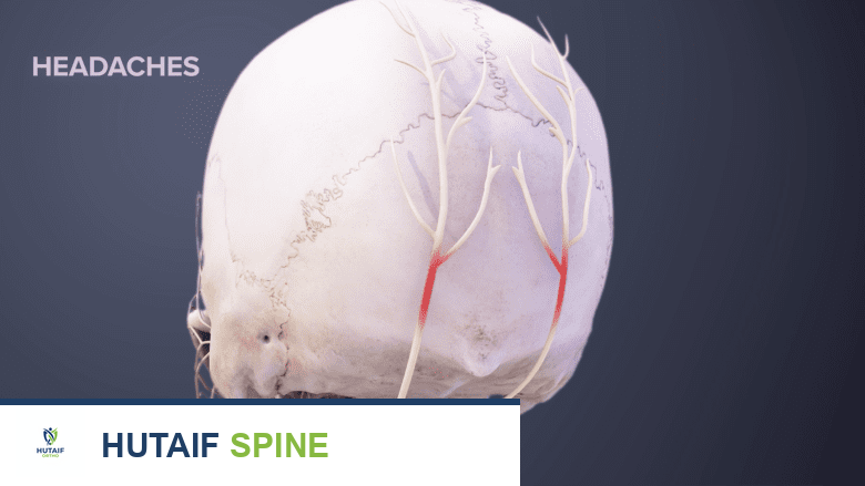 صورة توضيحية لـ متى يصبح تآكل فقرات الرقبة مؤلمًا؟ دليل شامل من الأستاذ الدكتور محمد هطيف