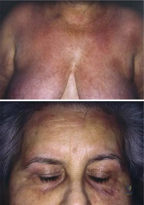 ABOS Board Review: SCFE, Köhler's Disease, Dermatomyositis, & Sprengel's Deformity | Part 32