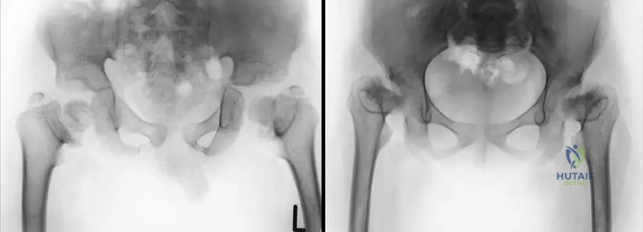 Spondyloepiphyseal Dysplasia MCQs | Ortho Board Prep