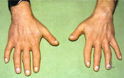 ABOS Board Review: Osteopetrosis, TRPS1, & Paget's Disease Comprehensive Guide | Part 4