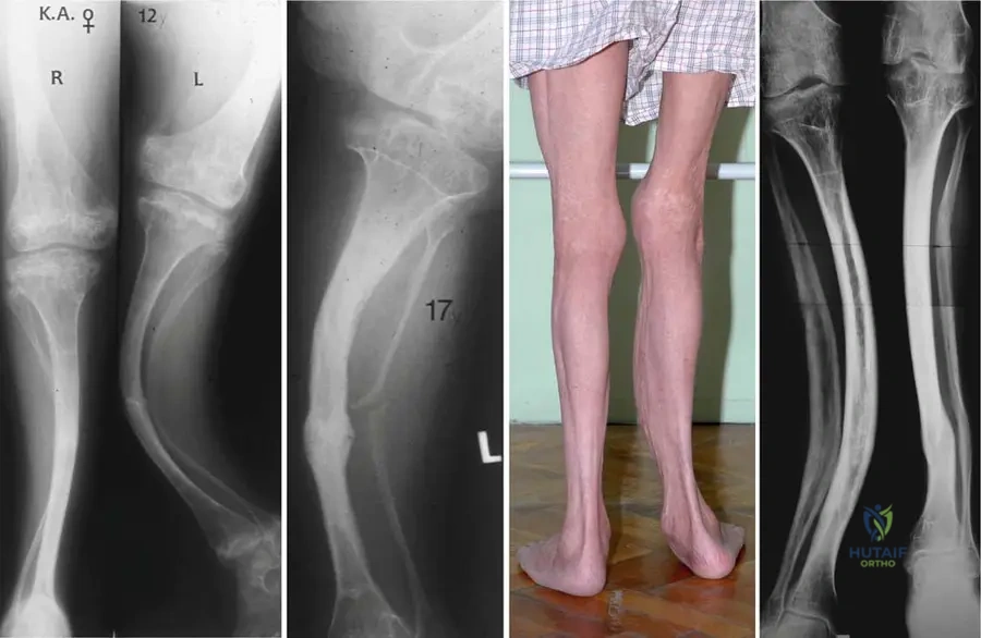 Master ABOS Board Review: Skeletal Dysplasias & Metabolic Bone Disease | Part 2