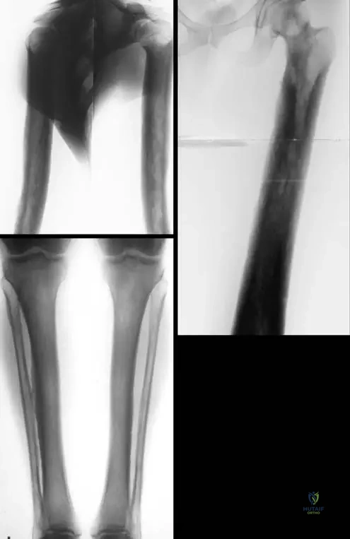 Master ABOS Orthopedic Board Review: Musculoskeletal Pathology & Bone Disorders | Part 12