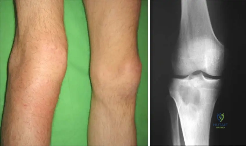 ABOS Orthopaedic Pathology Review: Bone Tumors, Infections & Synovial Lesions | Part 22
