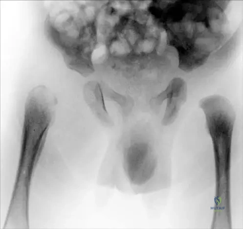 ABOS Board Review: Pediatric Orthopedics, Bone Tumors & Skeletal Dysplasias | Part 6