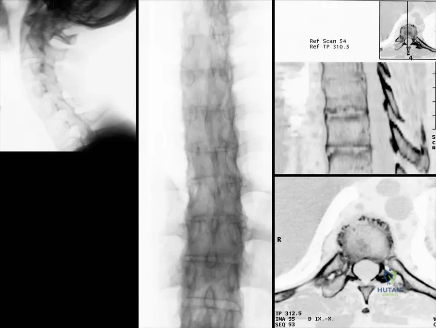 Orthopedic Board Review: Lipoma, Osteochondroma, AS, Synovial Chondromatosis MCQs | Part 15