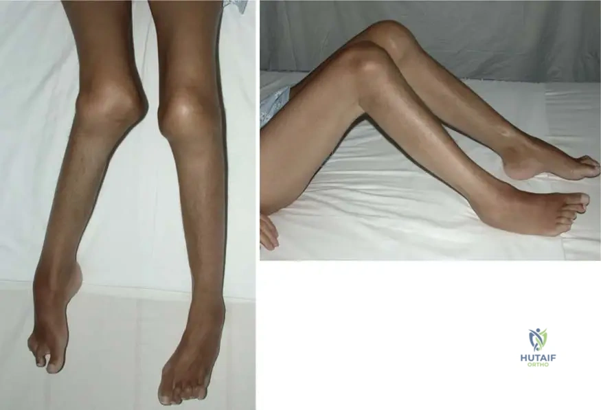 Master ABOS Orthopedic Board Review: Skeletal Dysplasias, Bone Tumors, & Arthropathy | Part 13