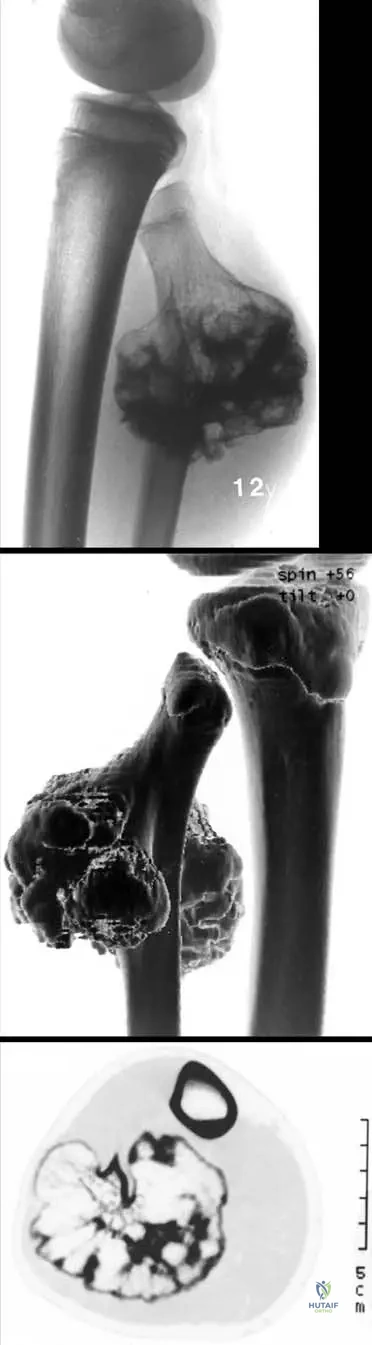 Orthopedic Board Review: Musculoskeletal Tumors, Ankylosing Spondylitis, Synovial Chondromatosis | Part 15