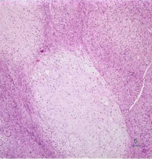 Master Orthopedic Board Review: Bone Tumors & Metabolic Diseases - Lymphoma, MPS, CMF | Part 11