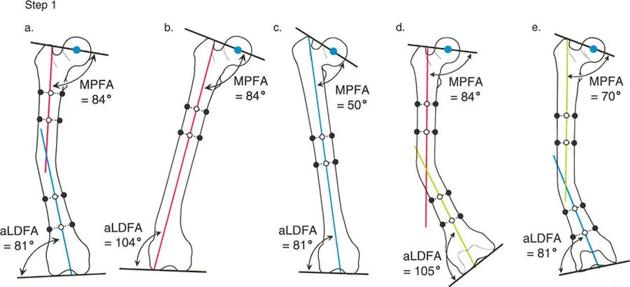 صورة طبية: تصحيح تشوهات الأطراف السفلية المتقدمة: دليل شامل للمرضى مع الأستاذ الدكتور محمد هطيف