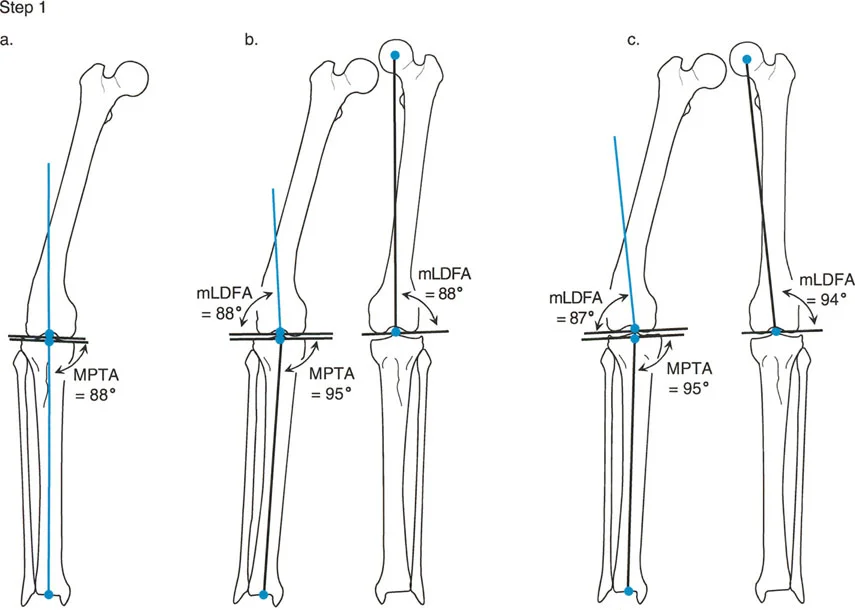 صورة توضيحية لـ تصحيح تشوهات الأطراف السفلية المتقدمة: دليل شامل للمرضى مع الأستاذ الدكتور محمد هطيف
