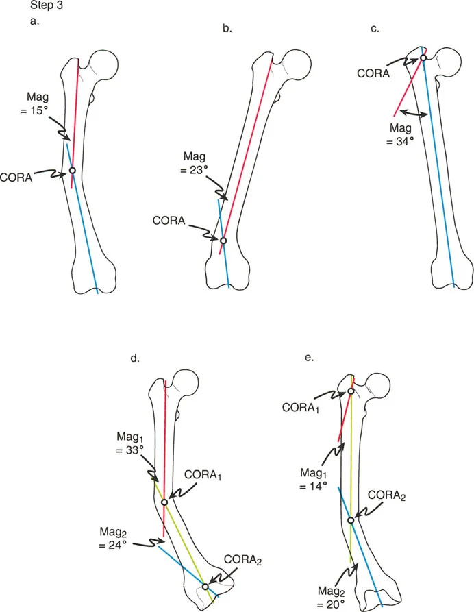 صورة طبية: تصحيح تشوهات الأطراف السفلية المتقدمة: دليل شامل للمرضى مع الأستاذ الدكتور محمد هطيف