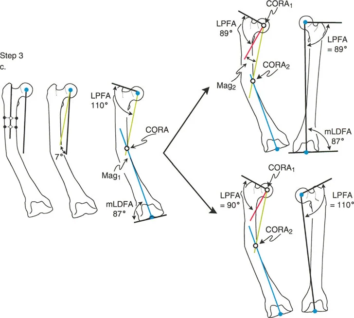 صورة توضيحية لـ تصحيح تشوهات الأطراف السفلية المتقدمة: دليل شامل للمرضى مع الأستاذ الدكتور محمد هطيف