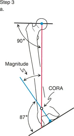 صورة توضيحية لـ تصحيح تشوهات الأطراف السفلية المتقدمة: دليل شامل للمرضى مع الأستاذ الدكتور محمد هطيف