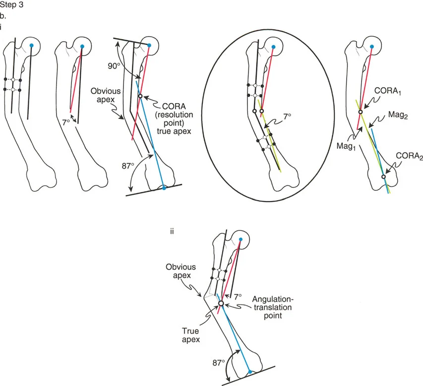 صورة توضيحية لـ تصحيح تشوهات الأطراف السفلية المتقدمة: دليل شامل للمرضى مع الأستاذ الدكتور محمد هطيف