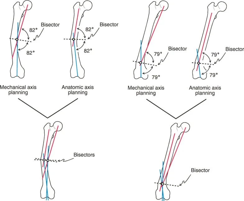 صورة بالأشعة السينية توضح تخطيط تشوه الفخذ المعزول بالمحور الميكانيكي