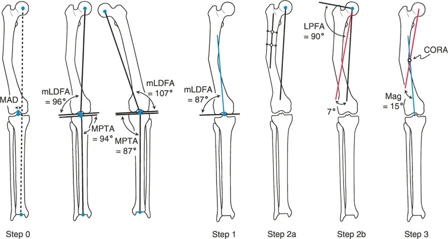 صورة توضيحية لـ تصحيح تشوهات الأطراف السفلية بالمنهج الدقيق (بالي): استعادة المحاذاة والحياة الطبيعية