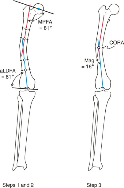 صورة بالأشعة السينية توضح تخطيط انحراف المحور الميكانيكي في الطرف السفلي