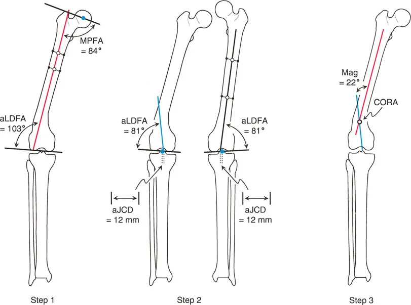 صورة بالأشعة السينية توضح تشوه متعدد القمم مع مراكز دوران زاوية متعددة
