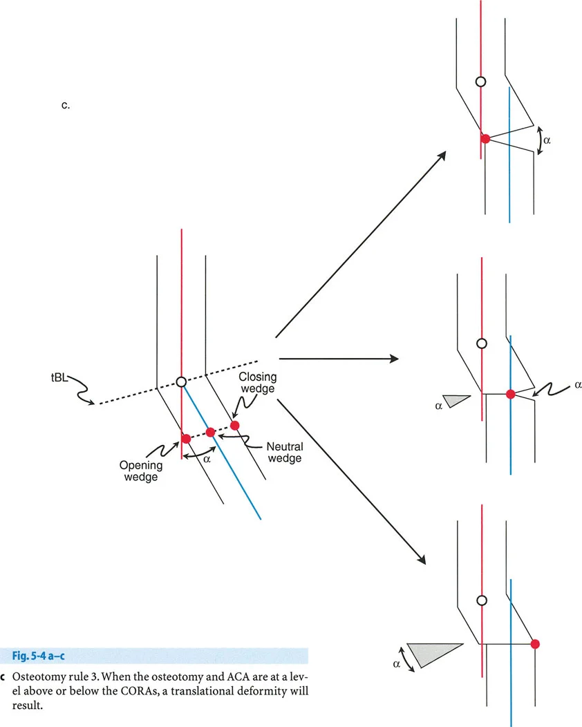 صورة توضيحية لـ جراحة بالي لتصحيح تشوهات العظام: دليلك الشامل لاستعادة استقامة أطرافك