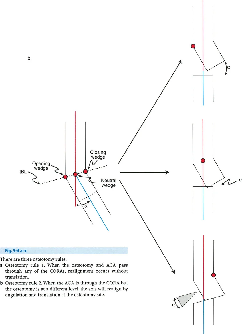 صورة توضيحية لـ جراحة بالي لتصحيح تشوهات العظام: دليلك الشامل لاستعادة استقامة أطرافك
