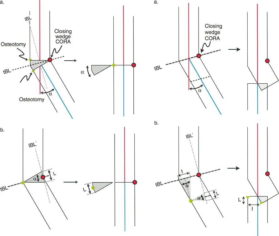 صورة توضيحية لـ تصحيح تشوهات الأطراف السفلية بقطع العظم: دليل مبادئ بالي الشامل