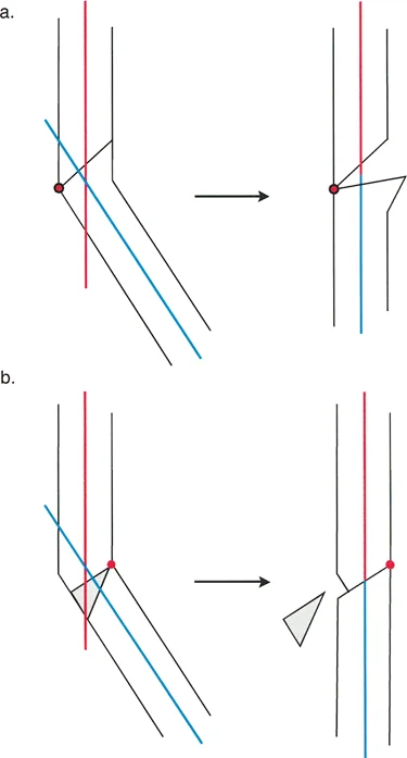 صورة توضيحية لـ قطع العظم بالي: حلول دقيقة لتصحيح تشوهات الأطراف واستعادة استقامتها