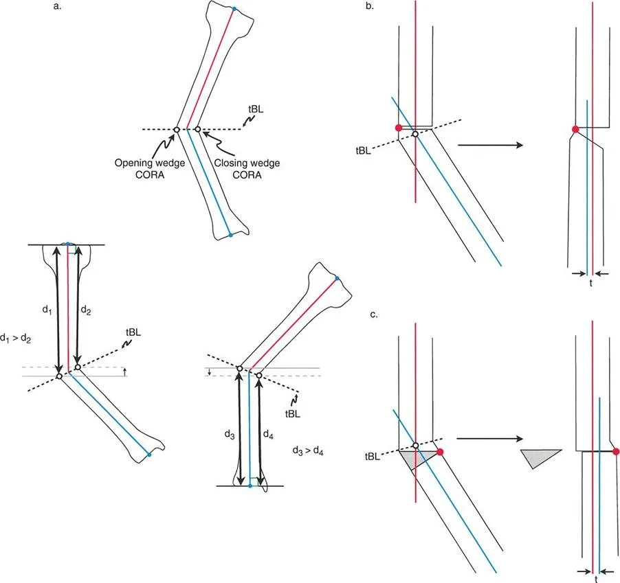 صورة توضيحية لـ قطع العظم بالي: حلول دقيقة لتصحيح تشوهات الأطراف واستعادة استقامتها