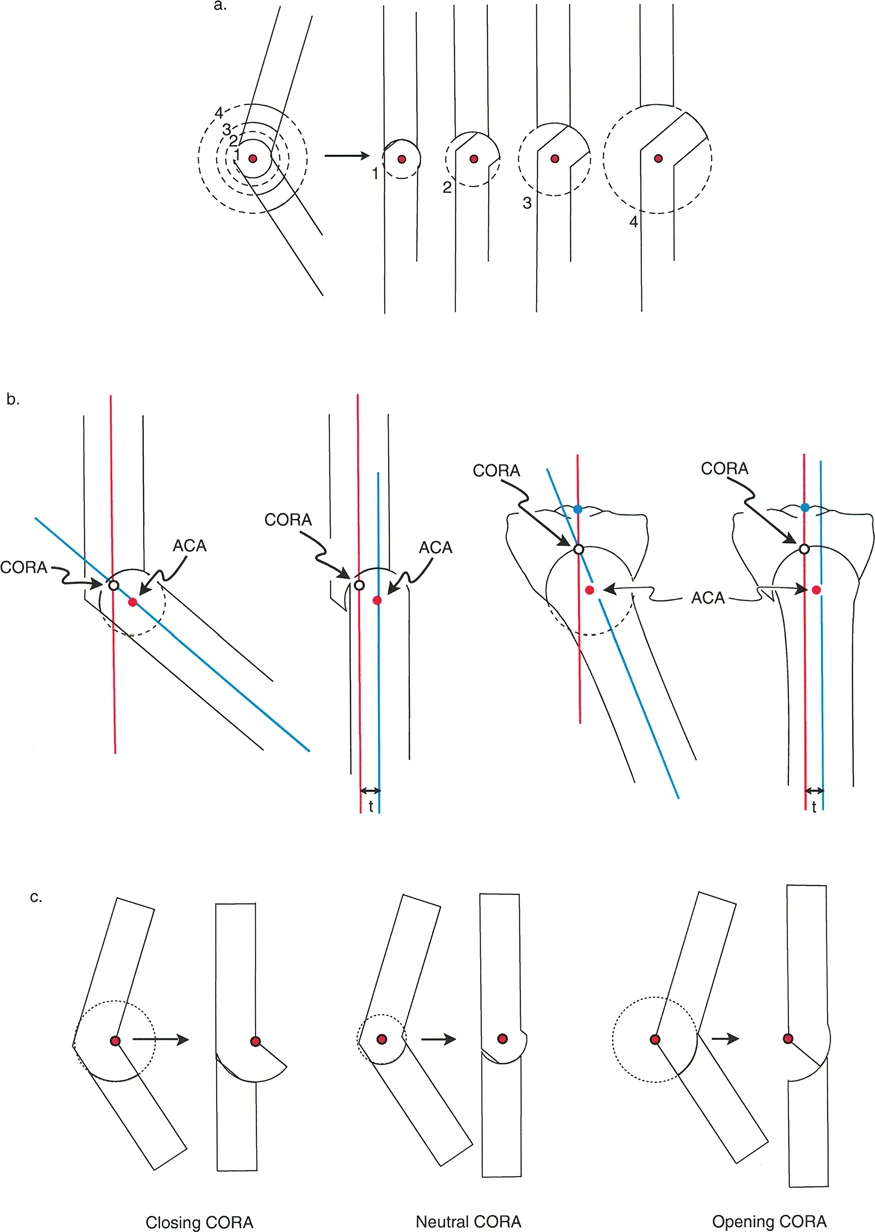 صورة توضيحية لـ قطع العظم بالي: حلول دقيقة لتصحيح تشوهات الأطراف واستعادة استقامتها