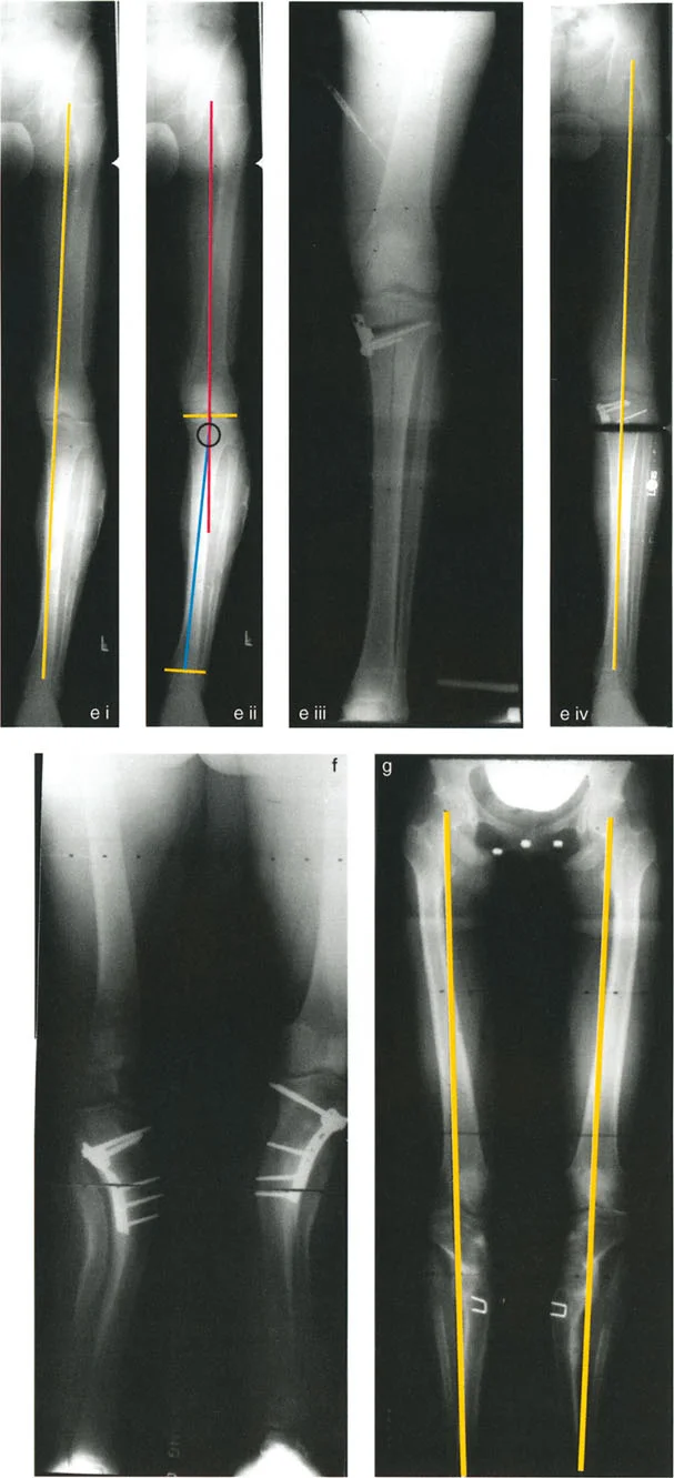 صورة طبية: إتقان قطع العظم القبة لتقويم تشوهات الأطراف: دليلك الشامل في صنعاء مع الأستاذ الدكتور محمد هطيف