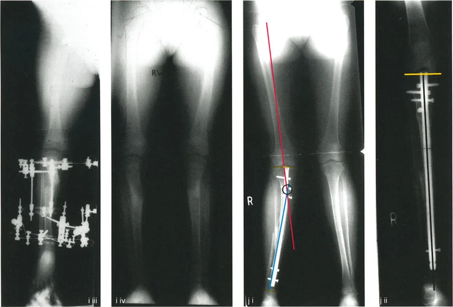 صورة طبية: إتقان قطع العظم القبة لتقويم تشوهات الأطراف: دليلك الشامل في صنعاء مع الأستاذ الدكتور محمد هطيف