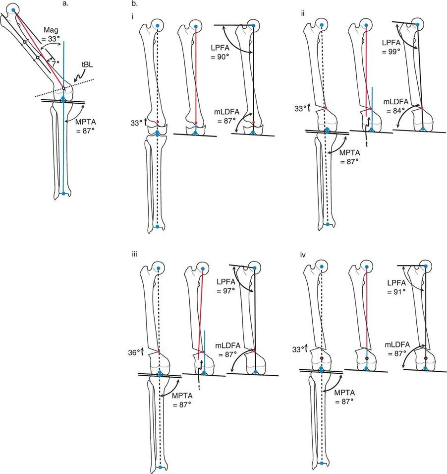 تقويم تشوهات الأطراف السفلية الدقيق: مفاهيم الدكتور بالي وإعادة محاذاة المحور الأمامي مع الأستاذ الدكتور محمد هطيف في صنعاء