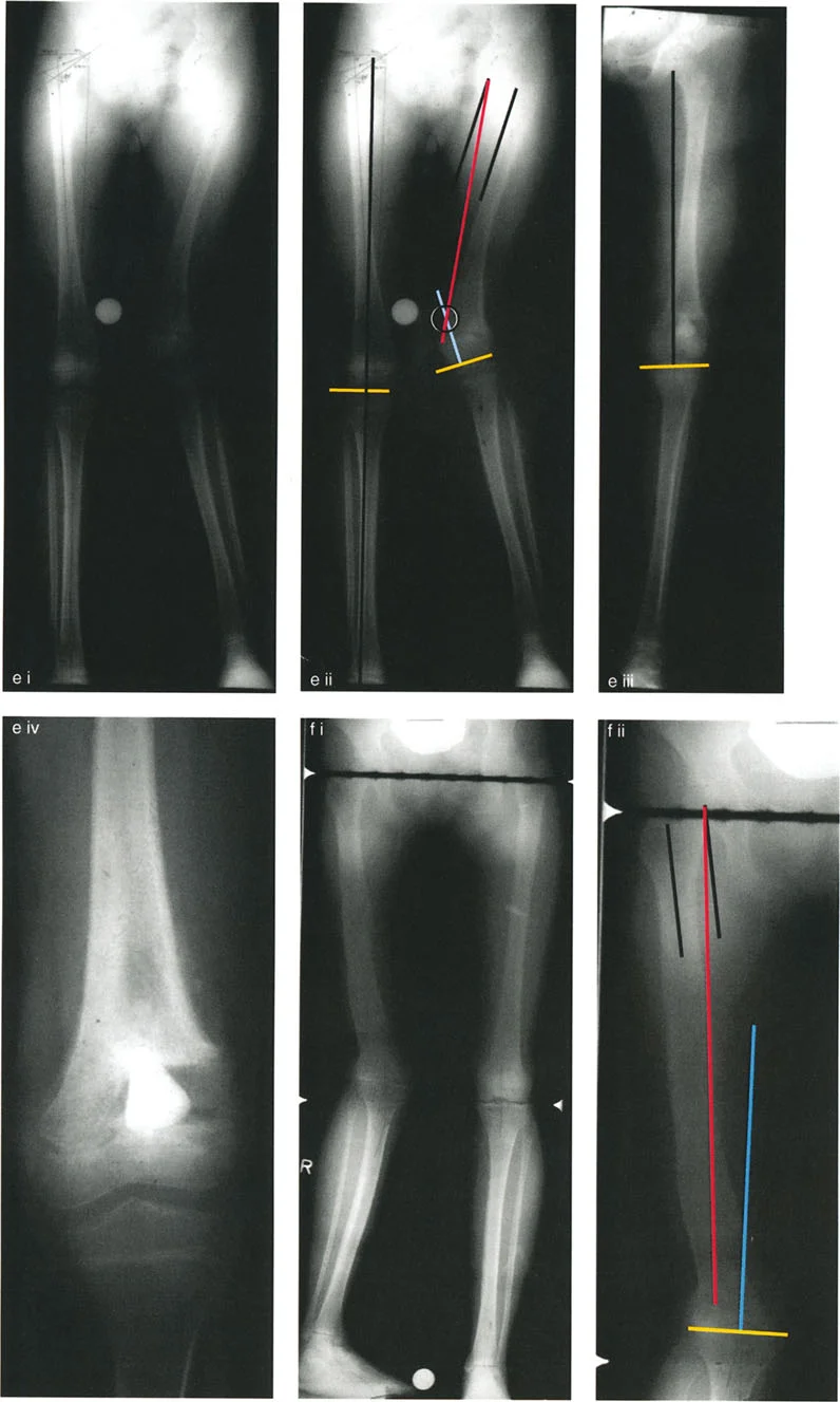 صورة توضيحية لـ تقويم تشوهات الأطراف السفلية الدقيق: مفاهيم الدكتور بالي وإعادة محاذاة المحور الأمامي مع الأستاذ الدكتور محمد هطيف في صنعاء