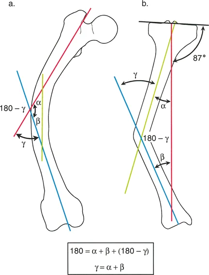 صورة طبية: تقويم تشوهات الأطراف السفلية بدقة متناهية: دليلك الشامل لمبادئ بالي المتقدمة ومركز دوران الانحراف (CORA)